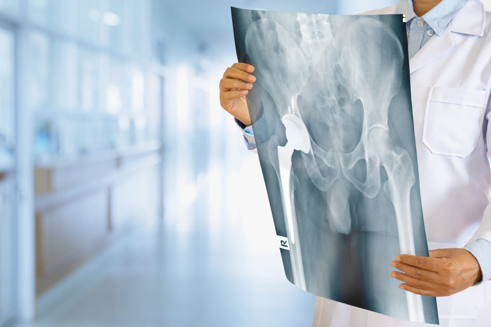 Doctor,Looking,At,Total,Hip,Replacement,X Ray,Film,With,Blurred